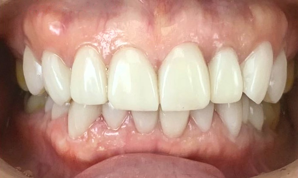 Dientes frontales después del tratamiento, con un tono brillante y parejo y formas naturales y uniformes