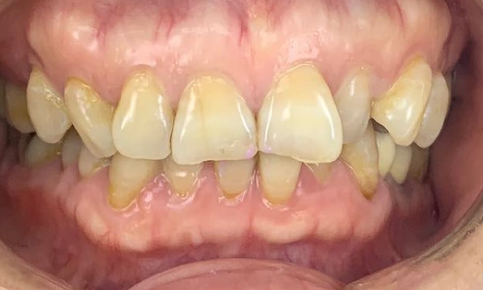Dientes frontales antes del tratamiento, amarillentos y manchados en la línea de las encías, con bordes desgastados y disparejos