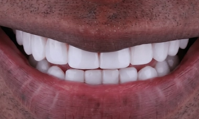 Smile after treatment, with bright, even front teeth