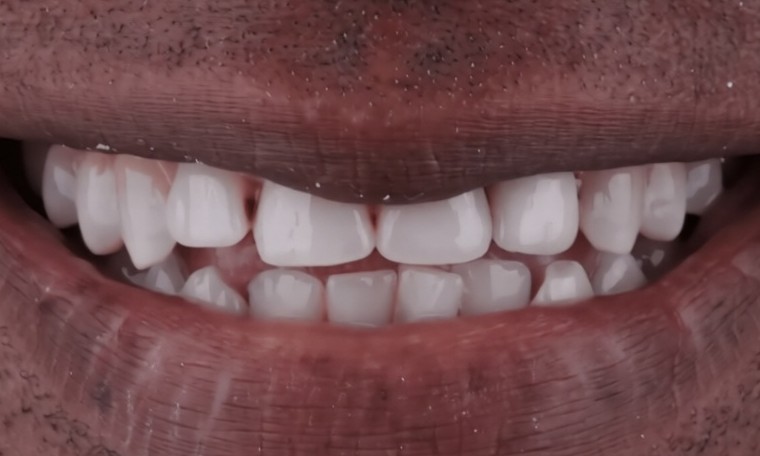 Smile before treatment, with uneven, irregular front teeth