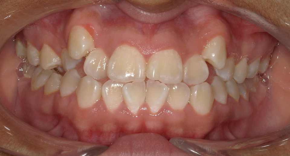 Front view of the teeth before treatment