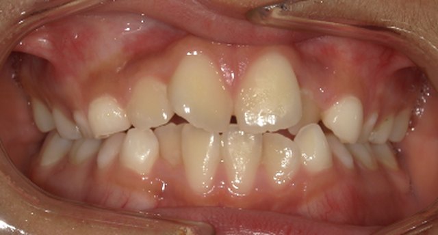 Front view of the teeth before treatment