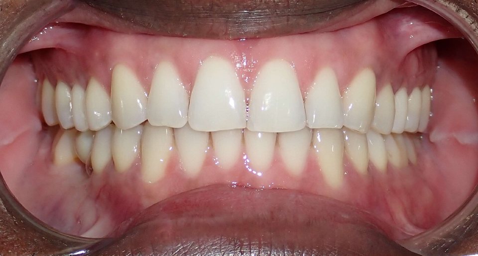 Front view of the teeth after treatment